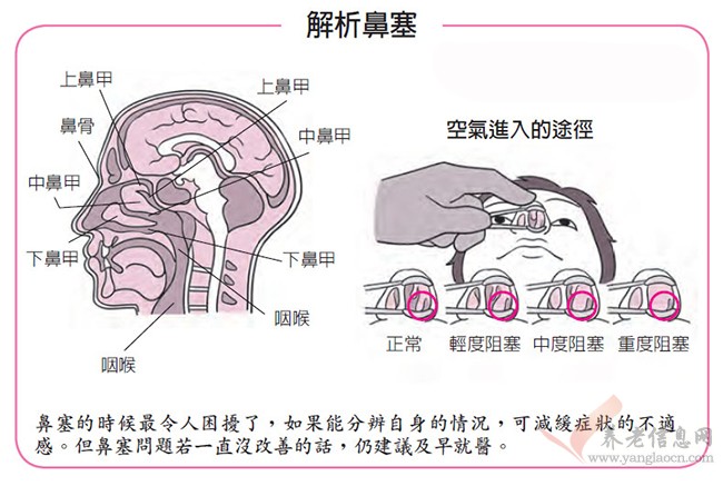 长期鼻塞，需区分鼻炎与鼻咽癌的差别，不可小觑！